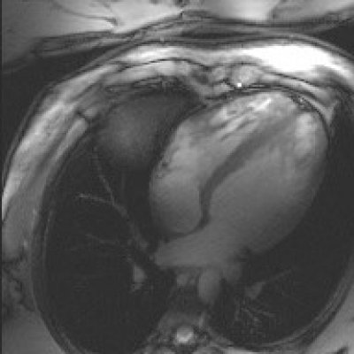 Researchers at UQ’s Centre for Advanced Imaging have begun performing the Southern Hemisphere’s most advanced cardiac imaging.